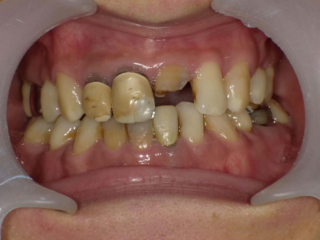 虫歯治療前ケース1