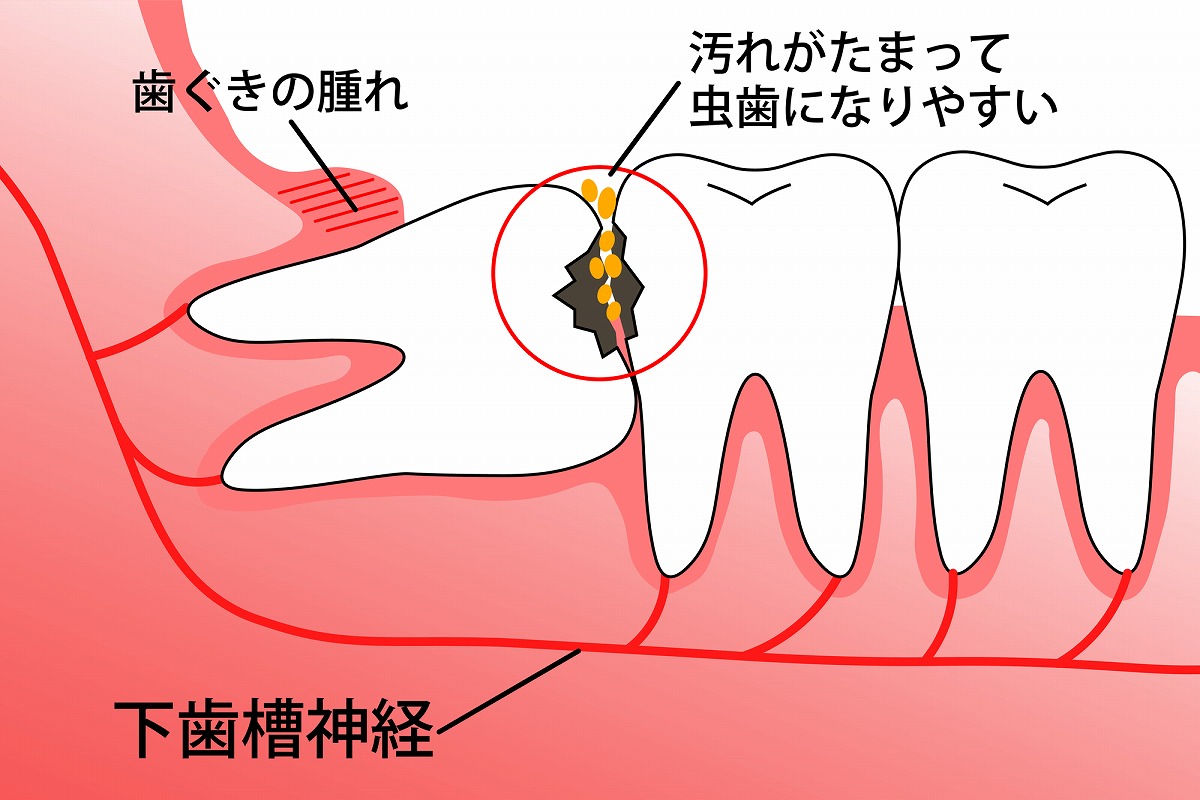 隣の歯にぶつかって斜めや横向きで生えている歯