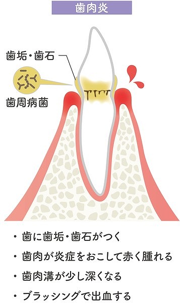 歯周炎（歯周ポケット 2〜4mm）