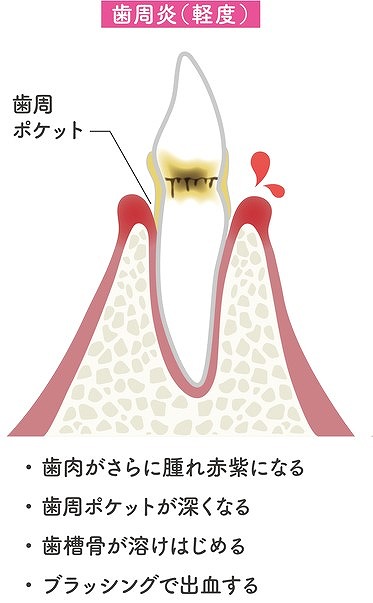 軽度な歯周炎（歯周ポケット 3〜5mm）