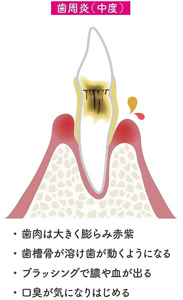 中度の歯周炎（歯周ポケット 4〜7mm）