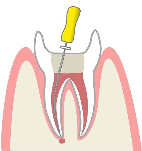 歯質の処理と歯髄の除去